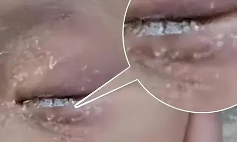 Bé 3 tuổi nhỏ keo 502 vào mắt, bố bình tĩnh cứu nguy trong 60 giây khiến bác sĩ cũng nể phục