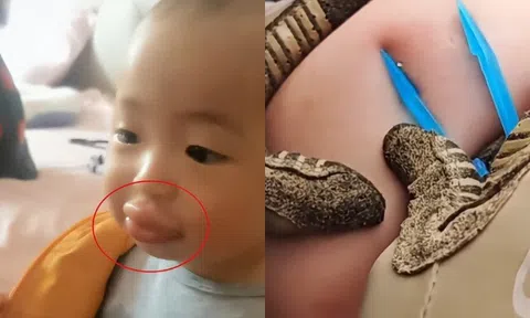 Con đi chơi bị ong đốt khiến môi sưng vù, người mẹ cứu sống con trong 20 phút, bác sĩ khen: Giỏi lắm!