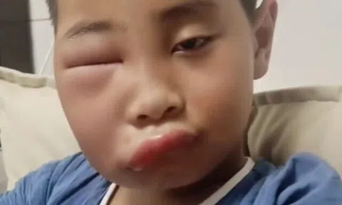 Vừa nghỉ hè cuối tuần về chơi với ông bà ở quê, bé trai khiến mẹ phát hoảng với gương mặt biến dạng