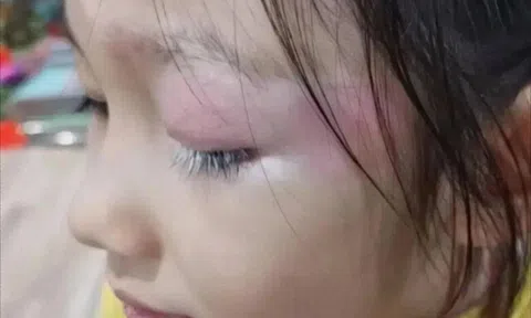Con gái xinh xắn bỗng mọc lông mi màu trắng kỳ lạ, mẹ hoang mang đưa đến bệnh viện khám, bác sĩ lắc đầu