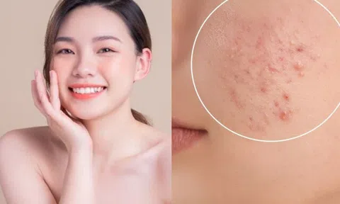 Da dễ sạm, đổ dầu và nổi mụn mùa Hè? Đây là những cách giúp làn da sáng khỏe hơn mỗi ngày