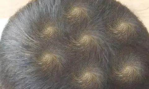 Đầu con trai bỗng xuất hiện 7 vòng xoáy kỳ lạ, người mẹ lo lắng đưa đến viện khám, bác sĩ không nói nên lời