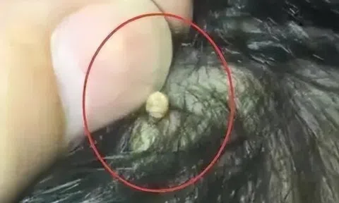 Bà nội vô tình thấy vật thể lạ bằng hạt gạo dính chặt trên đầu cháu gái, đưa đi khám bác sĩ thở phào