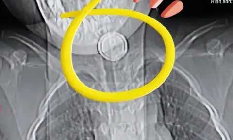Cháu nuốt nhầm pin cúc áo, bà nội cố gắng gây nôn nhưng mẹ đứa trẻ cản, BS khen: Chị rất thông minh!