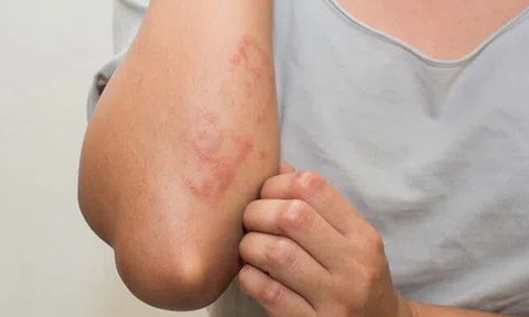 Cơn ngứa “chợt đến rồi đi” vô cùng khó chịu, nhiều người nghĩ gan có vấn đề nhưng lý do thật sự lại khá bất ngờ