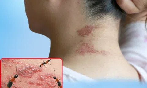 Kiến ba khoang "vào mùa" khiến cuộc sống người dân bị đảo lộn, nhiều người nhầm lẫn với zona thần kinh