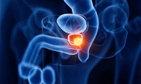 Gia đình có 4 người cùng mắc một loại ung thư, người trẻ nhất tử vong vì sai lầm tưởng chừng vô hại