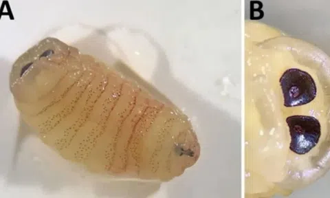 Hàng loạt ấu trùng ruồi khổng lồ đục khoét, làm lệch vách ngăn mũi bệnh nhân 58 tuổi