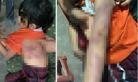 Bé gái lớp 2 bị bạn đánh bầm tím da, nguyên nhân do đâu?