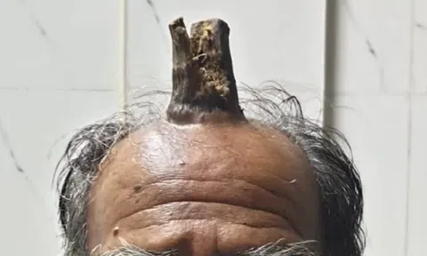 Câu chuyện kỳ lạ về người đàn ông bất ngờ mọc "sừng" dài hơn 10cm trên đầu