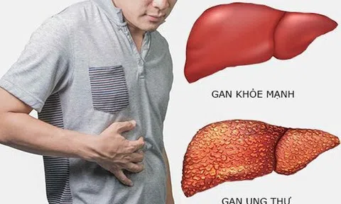 Bác sĩ chỉ ra 8 dấu hiệu cảnh báo ung thư gan sớm không nên bỏ qua