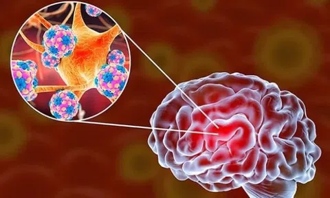 4 loại virus nguy hiểm bùng phát mùa hè đừng nhầm lẫn là cúm: Có 1 dấu hiệu xuất hiện phải nhập viện ngay