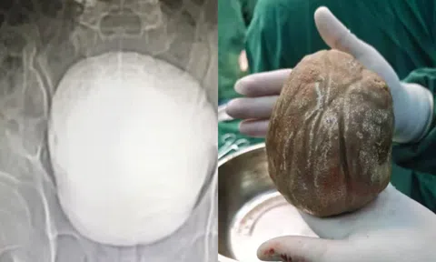 Tiểu ngắt quãng nhiều năm, người đàn ông bất ngờ phát hiện sỏi bàng quang khổng lồ nặng 1,3kg