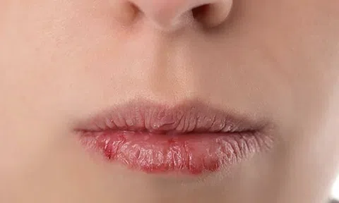 Muốn có một đôi môi hồng hào, căng mọng bạn hãy dừng lại ngay những thói quen này