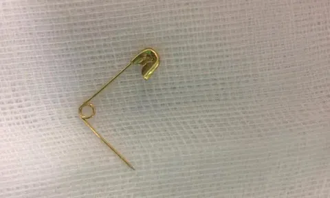 Quảng Ninh: Cấp cứu bé 18 tháng tuổi bị đồ chơi đâm sâu vào họng