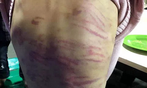 Vụ bé gái ở Hà Nội nghi bị mẹ ruột và người tình bạo hành: Xót lòng lời kể của nạn nhân