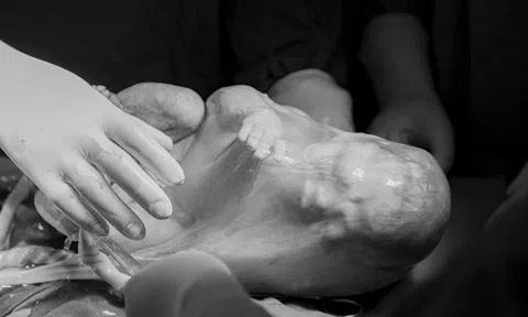 Hy hữu cặp song thai chào đời, 1 bé vẫn nằm ngoan trong bọc điều