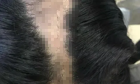 Bé gái mới 9 tuổi đã bị hói trắng đầu khiến bố mẹ hoang mang, nguyên nhân khiến ai cũng phải giật mình