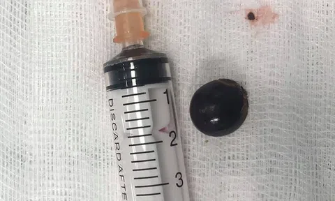 Bé trai 12 tuổi bị hóc hạt nhãn may mắn được cứu sống kịp thời