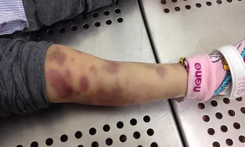 Điều tra vụ cháu bé 6 tuổi tử vong bất thường, nghi bị bạo hành