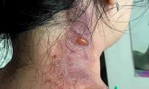Kiến ba khoang đốt nhưng bị chẩn đoán, dùng thuốc bệnh Zona thần kinh, nhiều người bị lở loét, nhiễm thêm độc tố