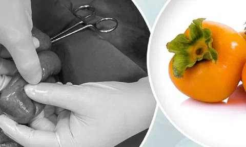 Tắc ruột vì ăn loại quả quen thuộc, cô gái 23 tuổi phải nhập viện gấp