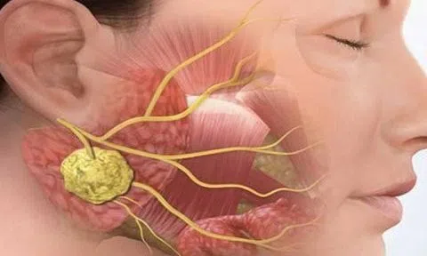 Dấu hiệu nhận biết sớm ung thư vòm họng