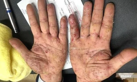 Xuất hiện sẩn ngứa cả gia đình bất ngờ khi được chẩn đoán bệnh