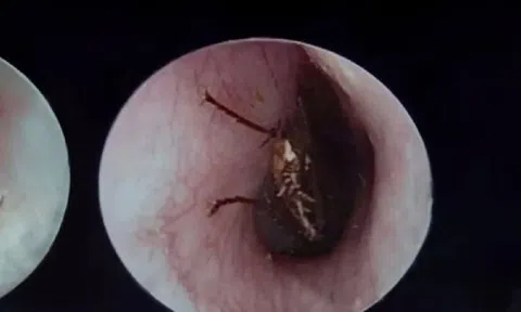 Bé bị gián bò vào tai, mẹ xử lý cách này được bác sĩ khen ngợi hết lời