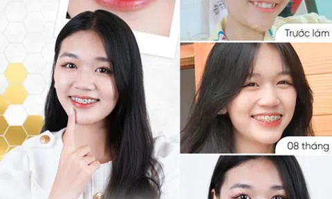 Niềng răng tại Tấm Dentist - Trào lưu làm đẹp mới của giới trẻ
