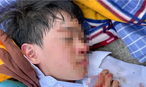Vụ nam sinh lớp 6 chảy máu đầu gây xôn xao: Công an lên tiếng về nguyên nhân