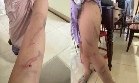 Cha đưa con gái 9 tuổi đến trình báo công an, sau khi phát hiện 34 vết bầm trên cơ thể con