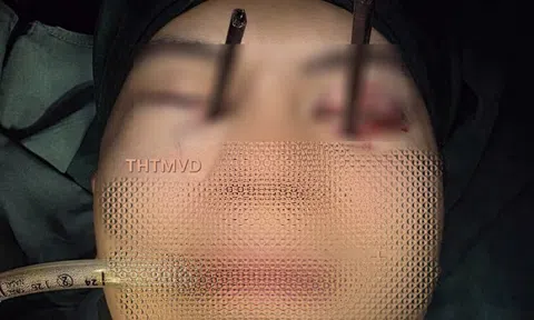 Hy hữu: Cấp cứu khẩn cấp nam thanh niên bị 2 chiếc đũa đâm xuyên cả hai mắt