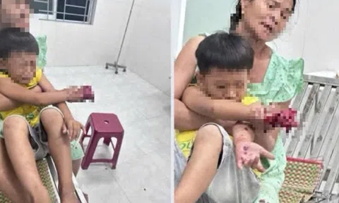 Tai nạn thương tâm: Điện thoại nghi phát nổ, bé trai 9 tuổi bị dập bàn tay phải