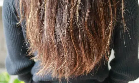 Rụng tóc nhiều vào mùa hè đừng chủ quan: 5 thói quen âm thầm gây hại