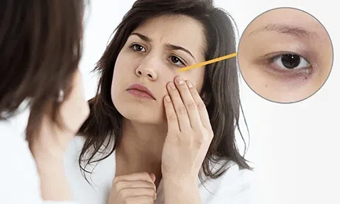 5 thực phẩm có thể hỗ trợ cải thiện quầng thâm mắt