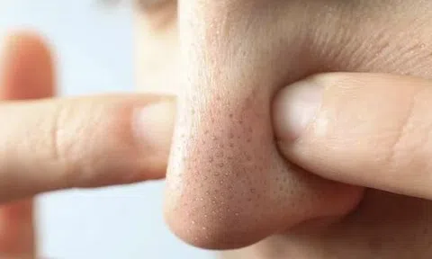 Mụn đầu đen mãi không hết? Có thể bạn vẫn đang mắc 5 thói quen này mỗi ngày