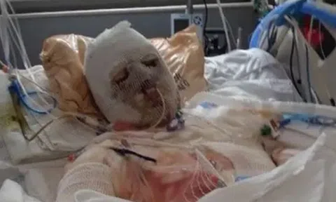 Người được phẫu thuật thay mặt thành công đầu tiên trên thế giới