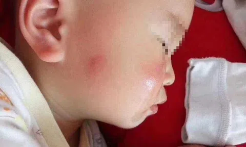 Bà nội chữa muỗi đốt theo cách lạ, cháu trai phải nhập viện cấp cứu gấp