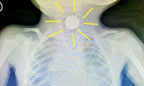 Bé trai 3 tuổi liên tục nôn mửa, bác sĩ kết luận bỏng thực quản vì "hung thần" quen thuộc của mọi nhà
