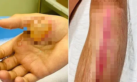 Bé trai 14 tuổi bỏng nặng phải nhập viện vì bắt chước làm kẹo đường như “Squid Game”