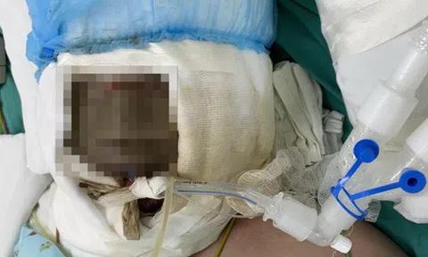 Ngã vào nồi nước xông phòng COVID-19, bé gái 14 tuổi bị bỏng nguy kịch