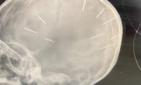 Nóng: Gã nhân tình của người mẹ là nghi phạm chính bắn đinh vào đầu bé gái 3 tuổi