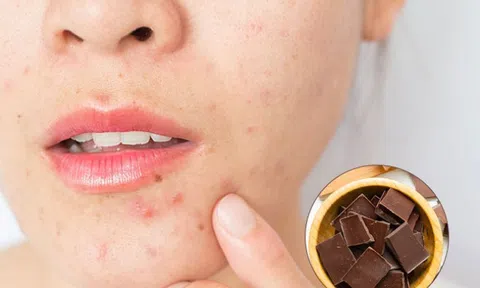 Socola gây hại ra sao khi ăn quá nhiều?