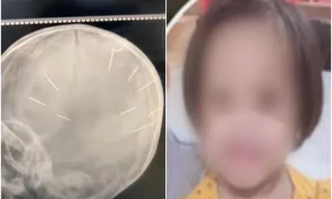 Sức khỏe bé 3 tuổi bị nhân tình của mẹ găm 9 chiếc đinh vào đầu giờ ra sao?