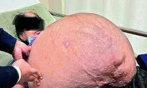 Bụng người phụ nữ to như mang đa thai, bí mật về “quái vật” đeo bám 18 năm gây choáng