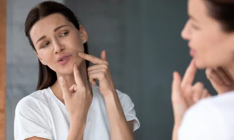 Mụn nội tiết là gì? Có điều trị được không?