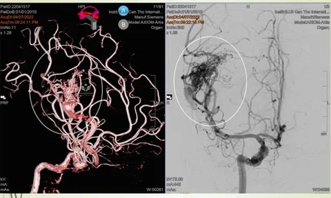 Bé gái 10 tuổi nguy kịch vì đột quỵ, chuyên gia cảnh báo điều quan trọng
