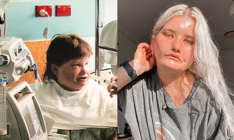 Căn bệnh khiến cô gái có khuôn mặt luôn cau có, cả đời không thể cười