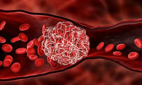 Cảnh giác nguy cơ đột quỵ hậu COVID-19